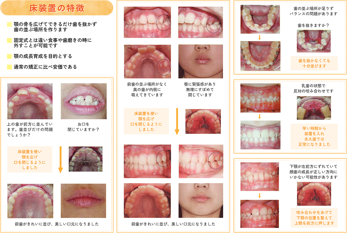 床装置の特徴